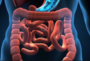 Único tratamiento para combatir el síndrome de intestino corto