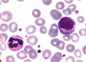 Un gen podría frenar la leucemia más común en niños
