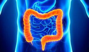 Nueva técnica para curar el cáncer colorrectal