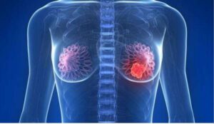Nuevo tratamiento para el cáncer de mama avanzado